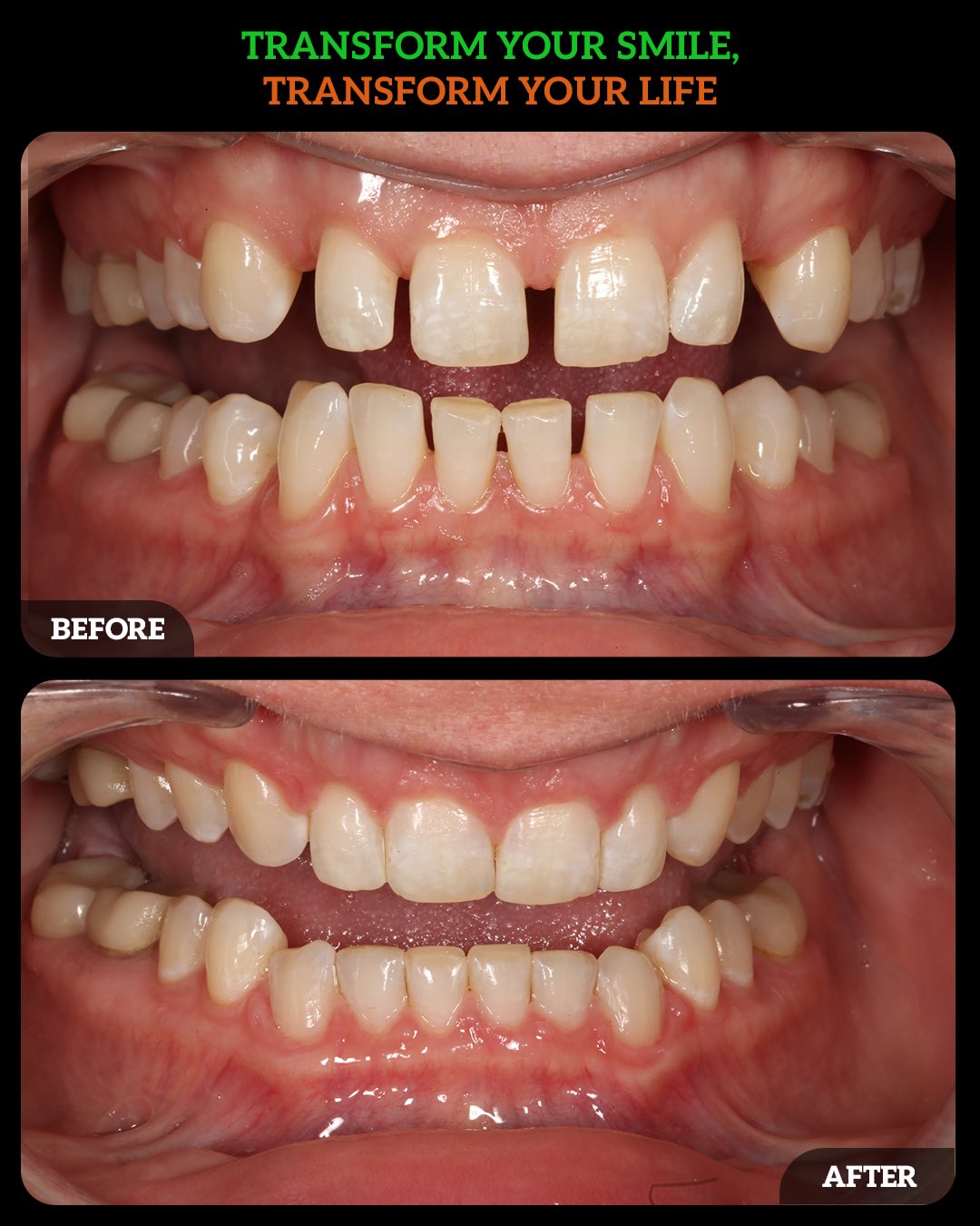 invisalign dublin ohio23