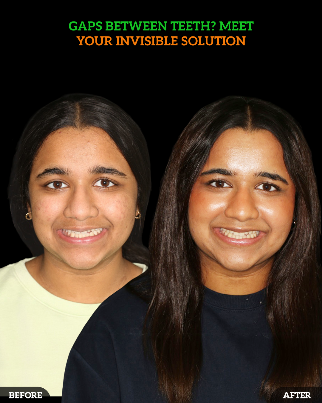 invisalign teen 1