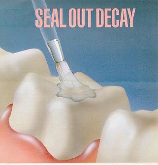 Dental Poster Decay Sealants Fillings